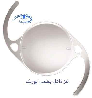 لنز داخل چشمی توریک در درمان قوز قرنیه